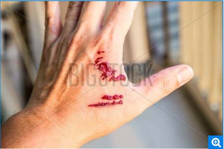 image 3 Navigating Dog Bite Injuries in Michigan: A Comprehensive Legal Guide for Victims